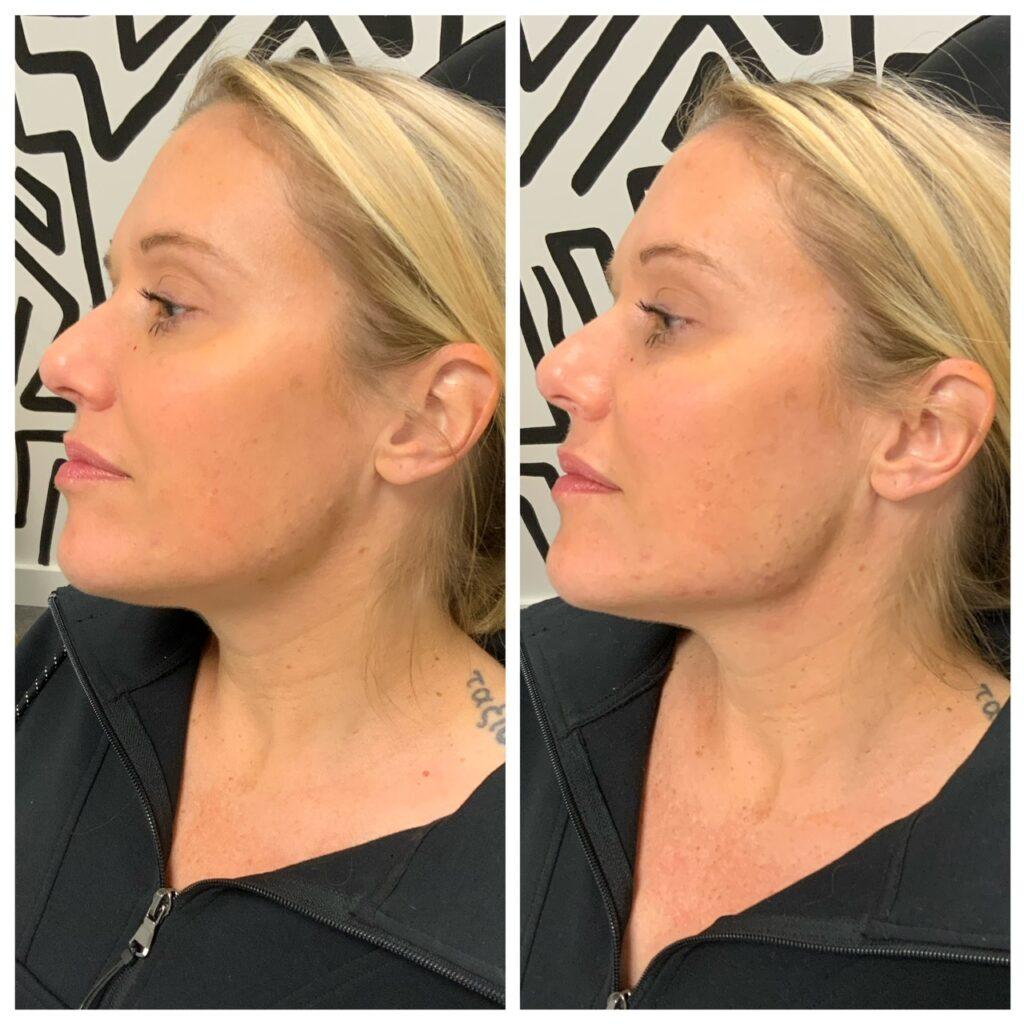 Jaw Enhancement before & after
