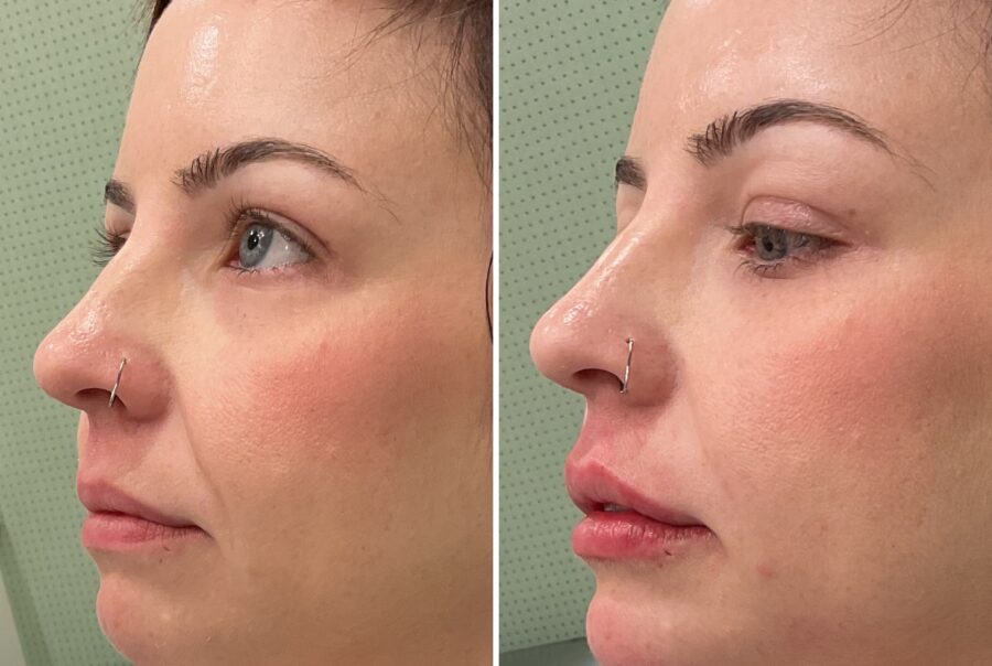 Lip filler & chin enhancement before and after