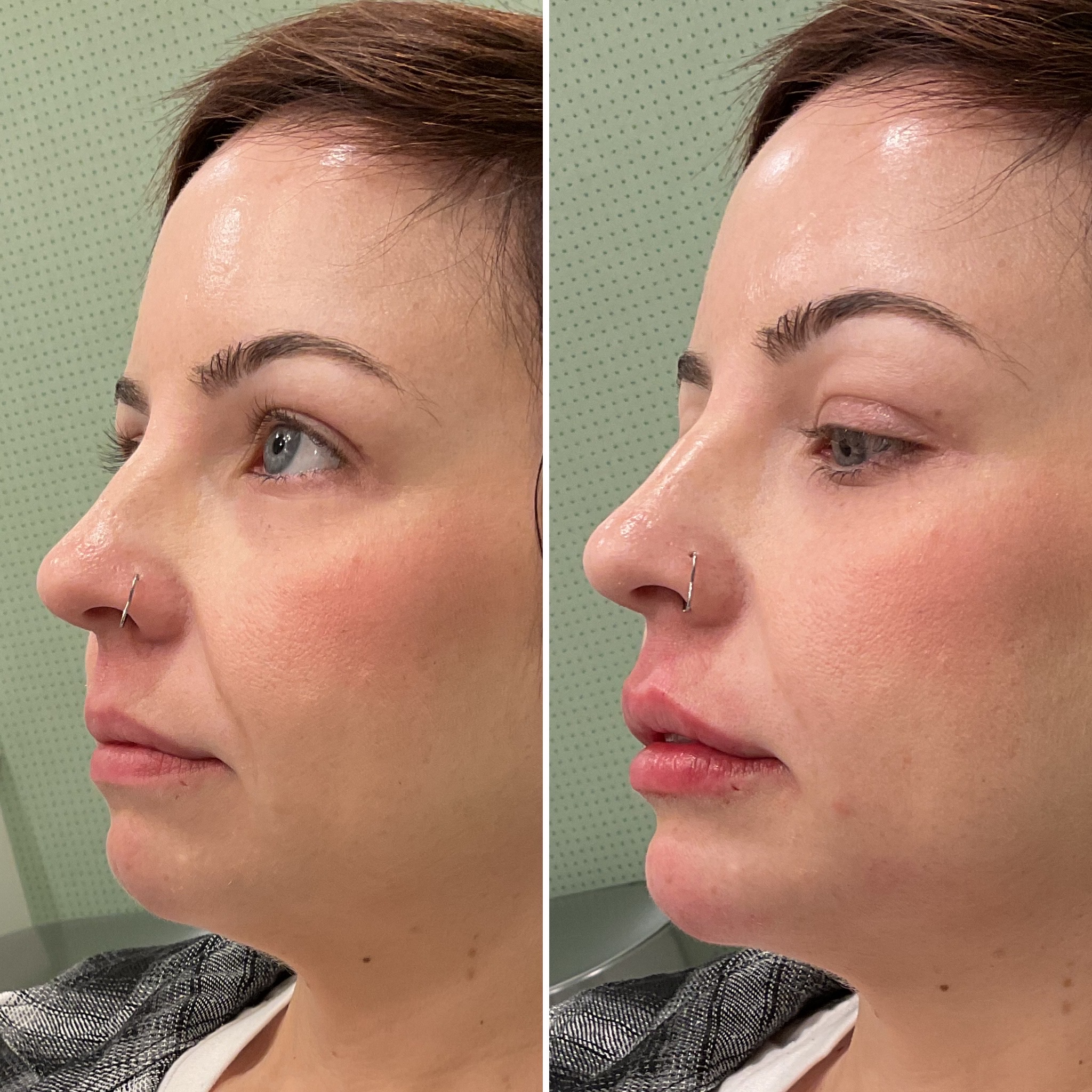 Lip filler & chin enhancement before and after