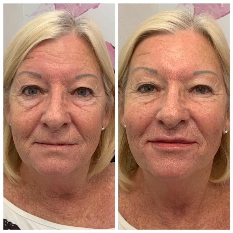 CHEEK FILLER before and after