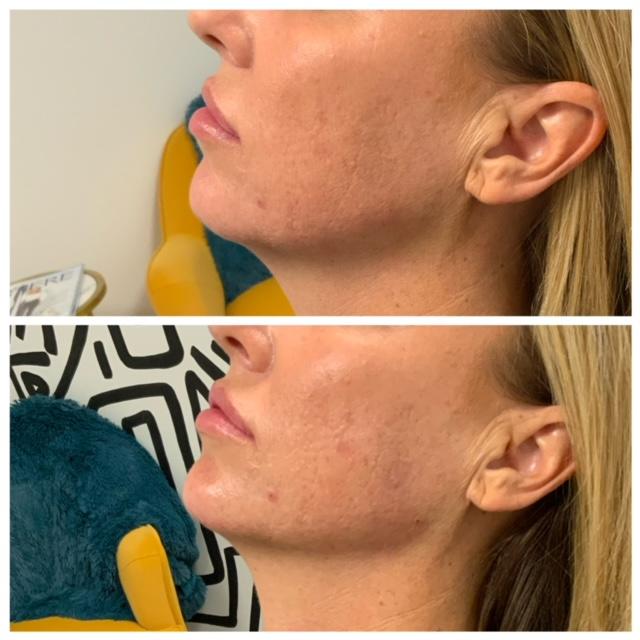 Chin and Jaw Enhancement - Before & After