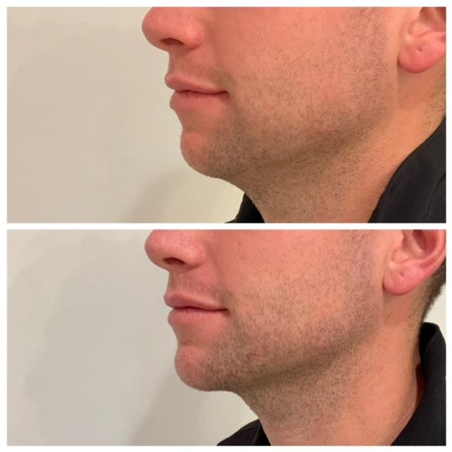 Jaw Enhancement - Before & After