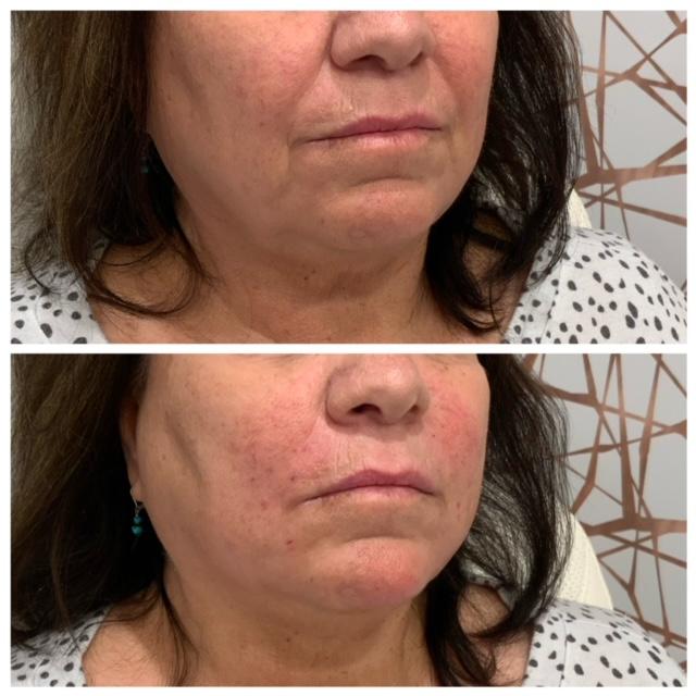 Lower Face Rejuvenation - Before & After