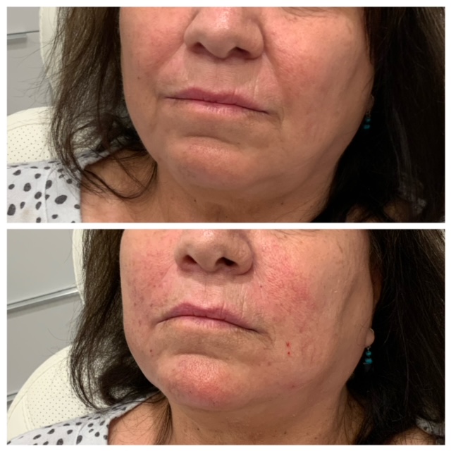Lower Face Rejuvenation - Before & After