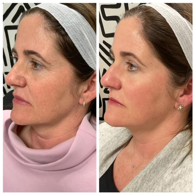 TCA Peel - Before & After