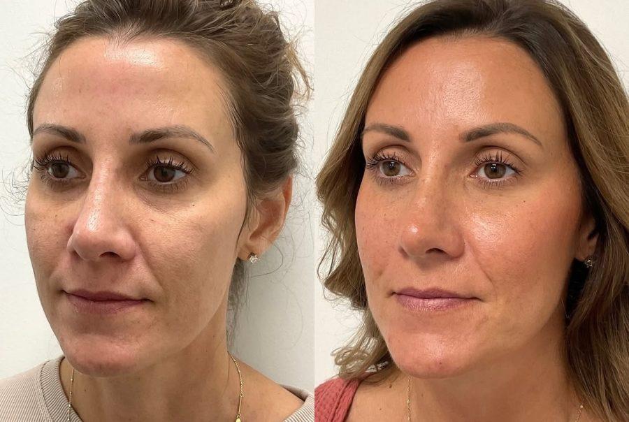 Before and after of significantly improved undereyes using EZ GEL PRP or PRF